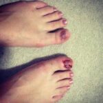 Eva-salsa dance injury